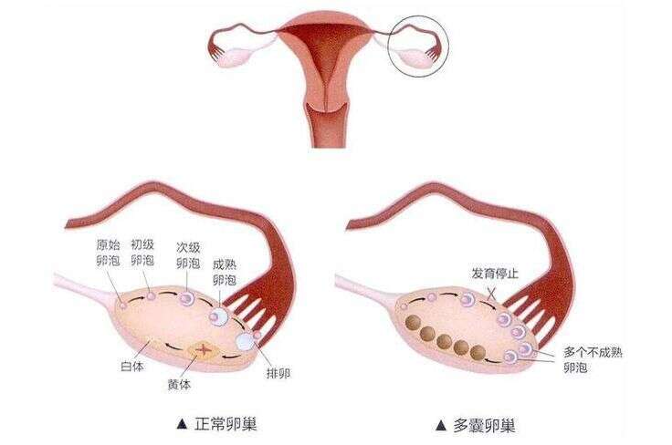 多囊卵巢