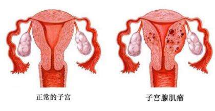 多囊卵巢综合症为何难怀孕